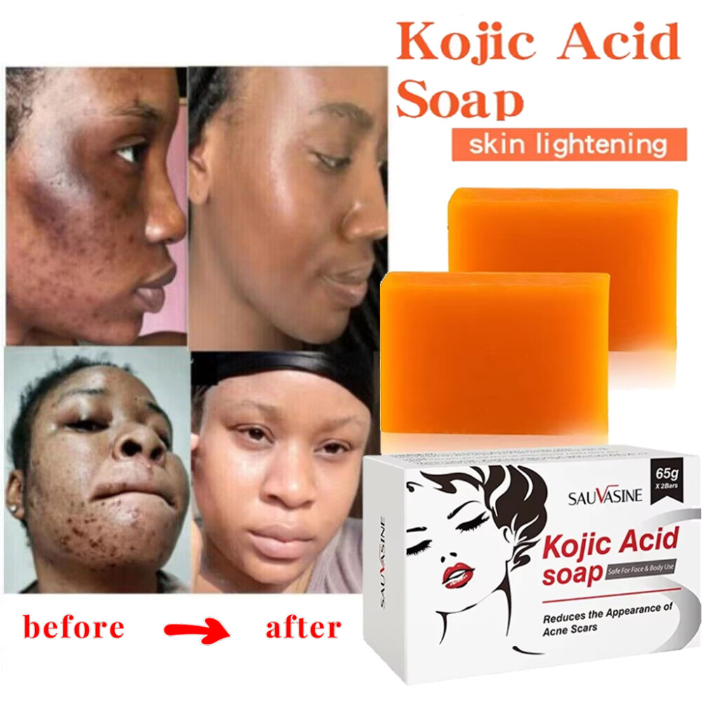 5/3X Kojic Acid Soap Acne Dark Spot Remover Skin Lightening Whitening Face Body
