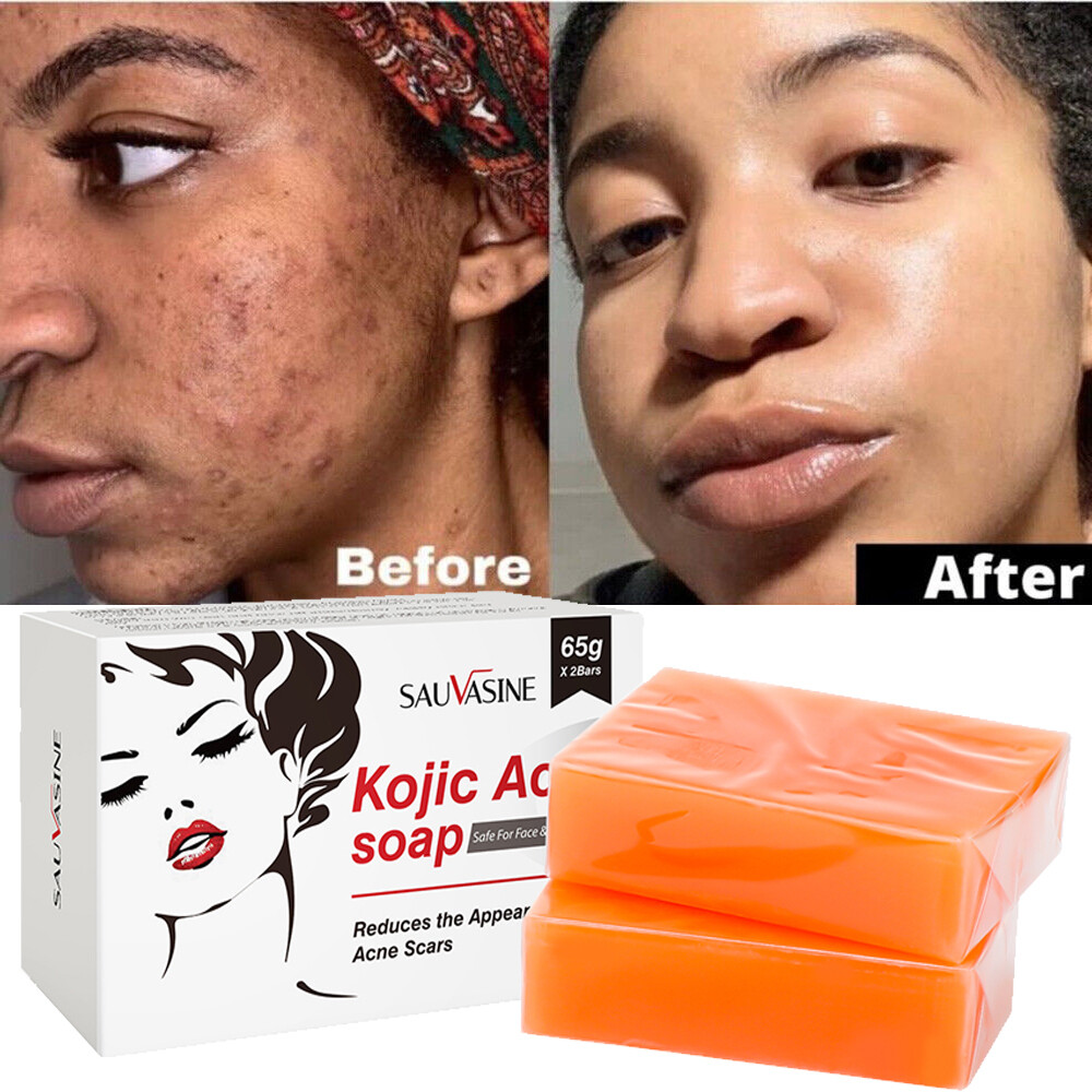 5/3X Kojic Acid Soap Acne Dark Spot Remover Skin Lightening Whitening Face Body
