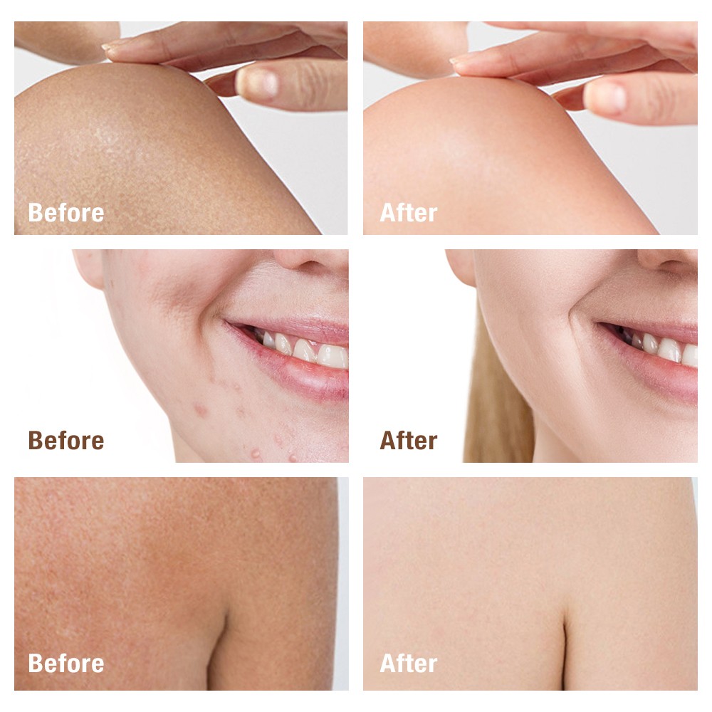 5/3X Kojic Acid Soap Acne Dark Spot Remover Skin Lightening Whitening Face Body
