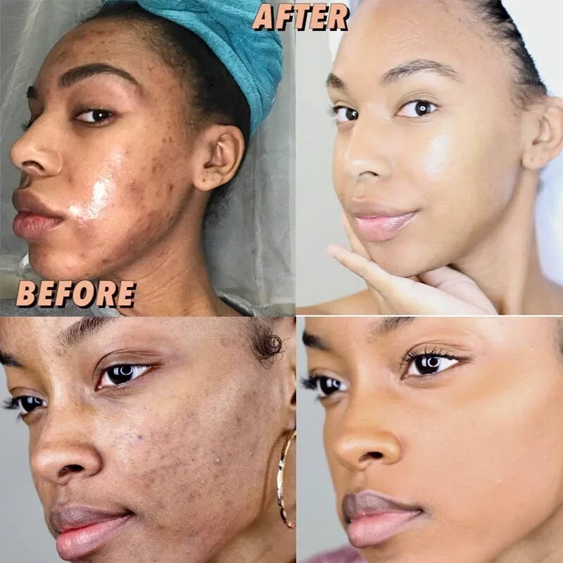 Kojic Acid Soap Dark Skin Whitening Bleaching Lightening Brightening Face & Body