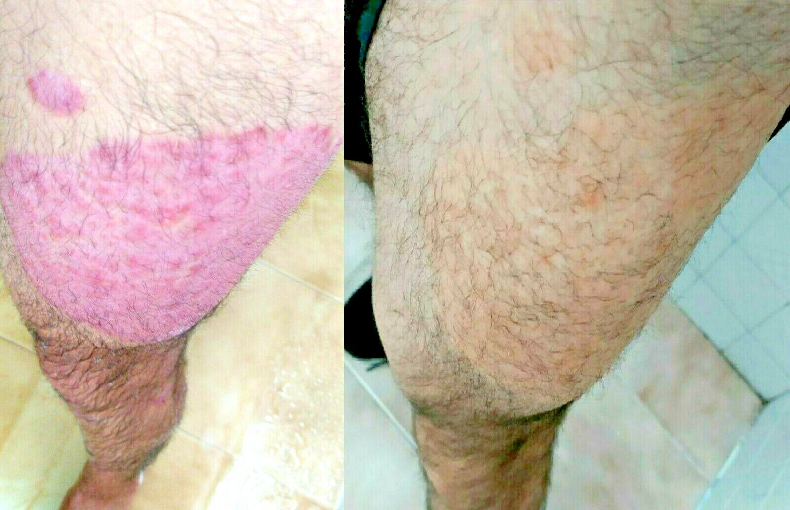 Psoriasis, Seborrheic Dermatitis and Dandruff Soap Dermabon FREE SHIPPING