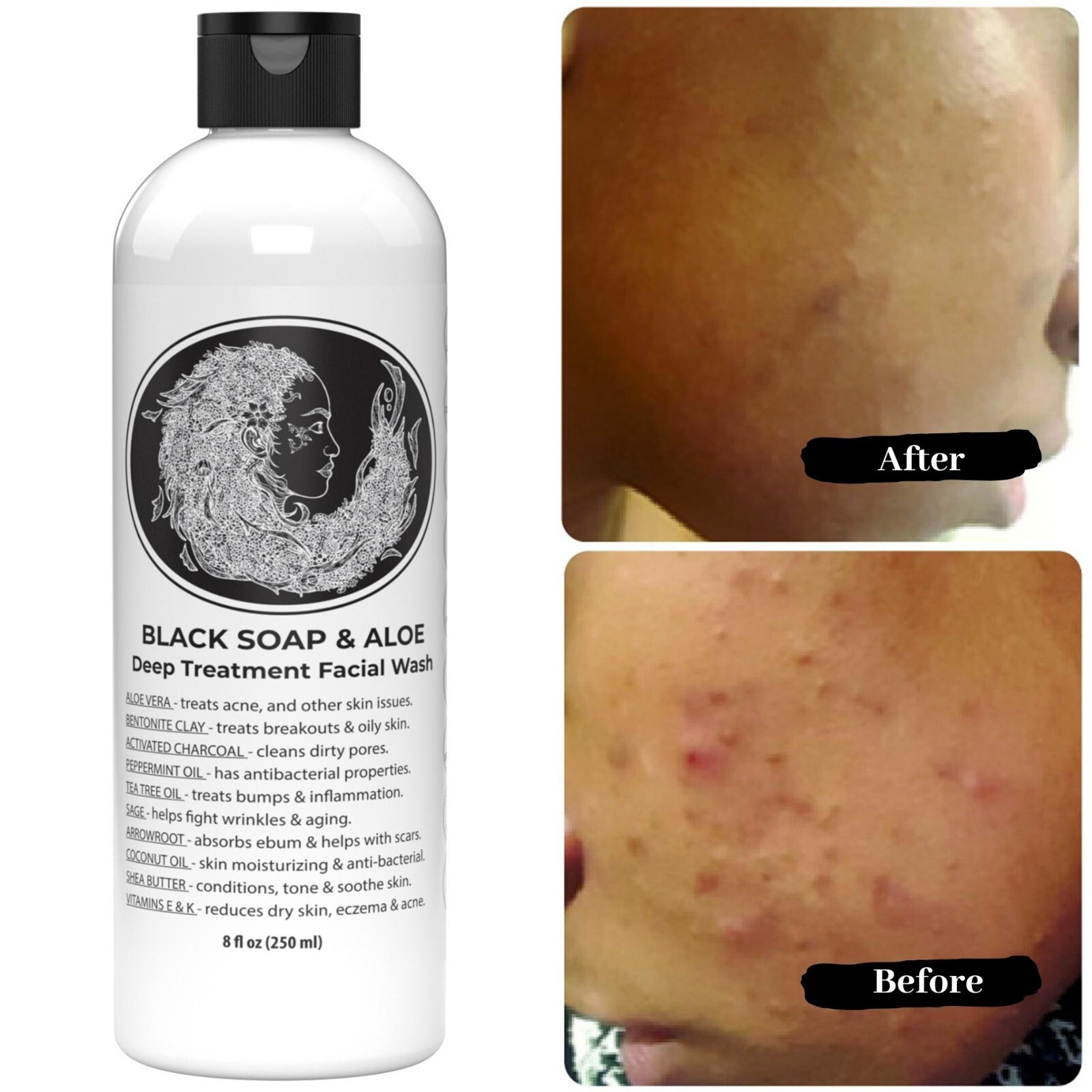 Navigating Acne Soap Options on eBay