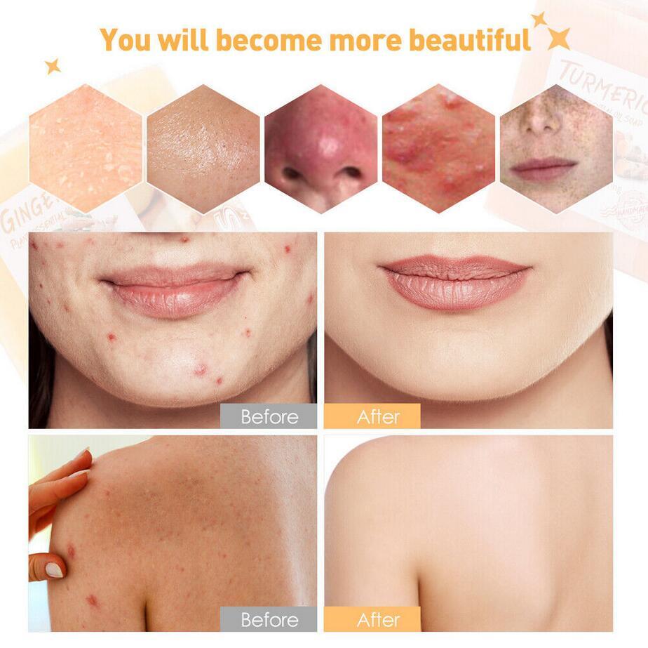 Tumeric Soap Skin Whitening Dark Spots lightening Acne Brightening Turmeric New