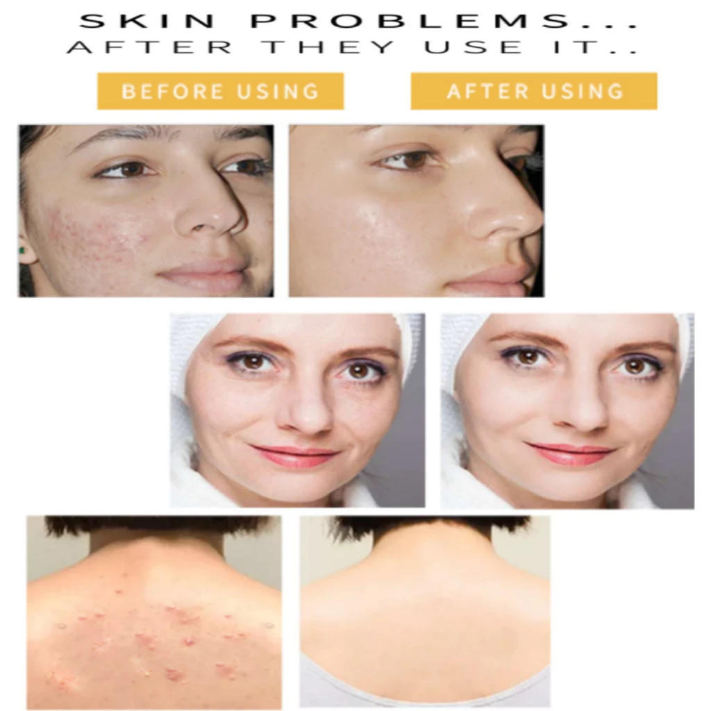 Kojie San Soap For Brightening Reduce Dark Spots Acne Scars 2 Of 65g