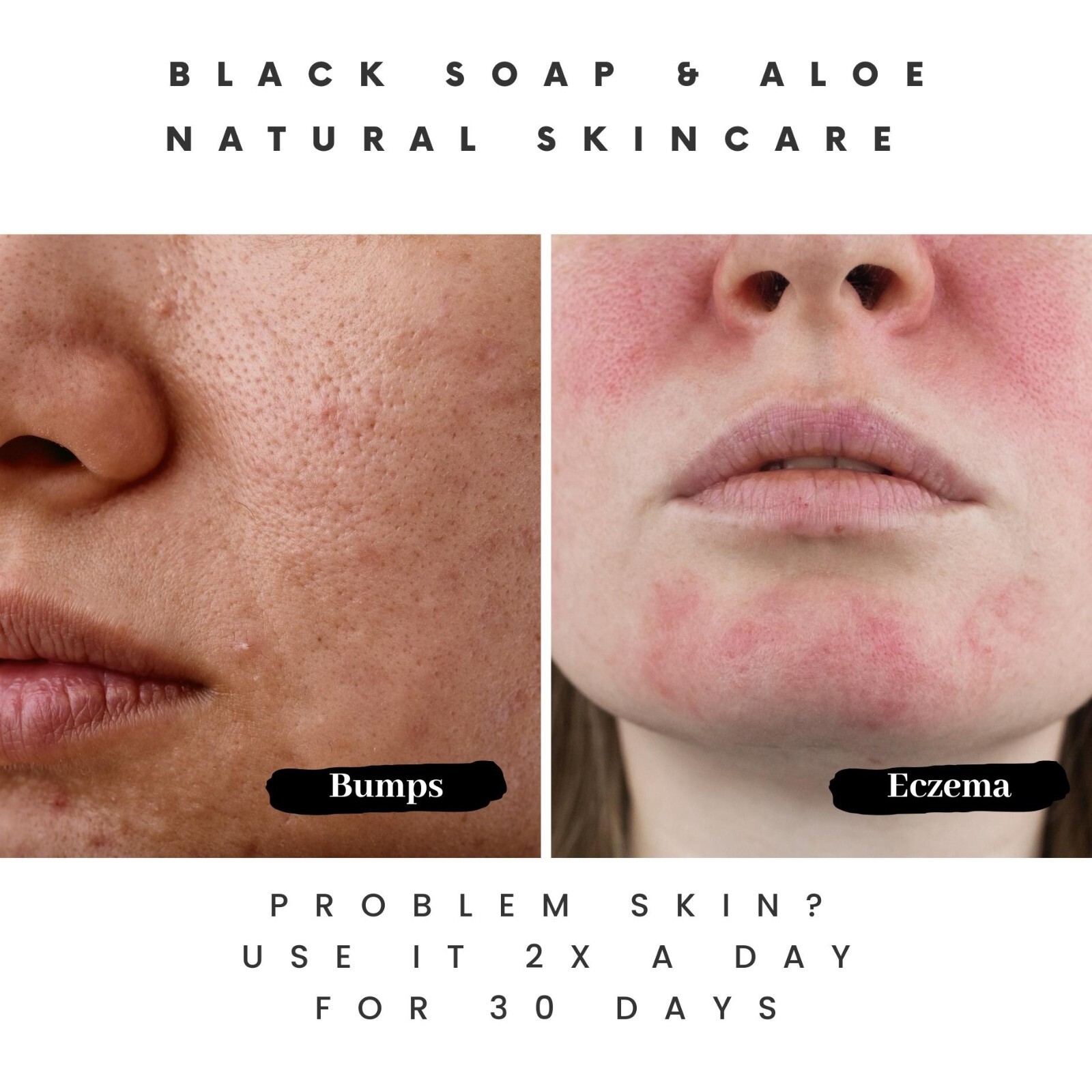 Navigating Acne Soap Options on eBay