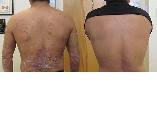 Kengold (Pack Of 2) Psoriasis Skin & Hair Soap Pain Relief Natural 75 gram