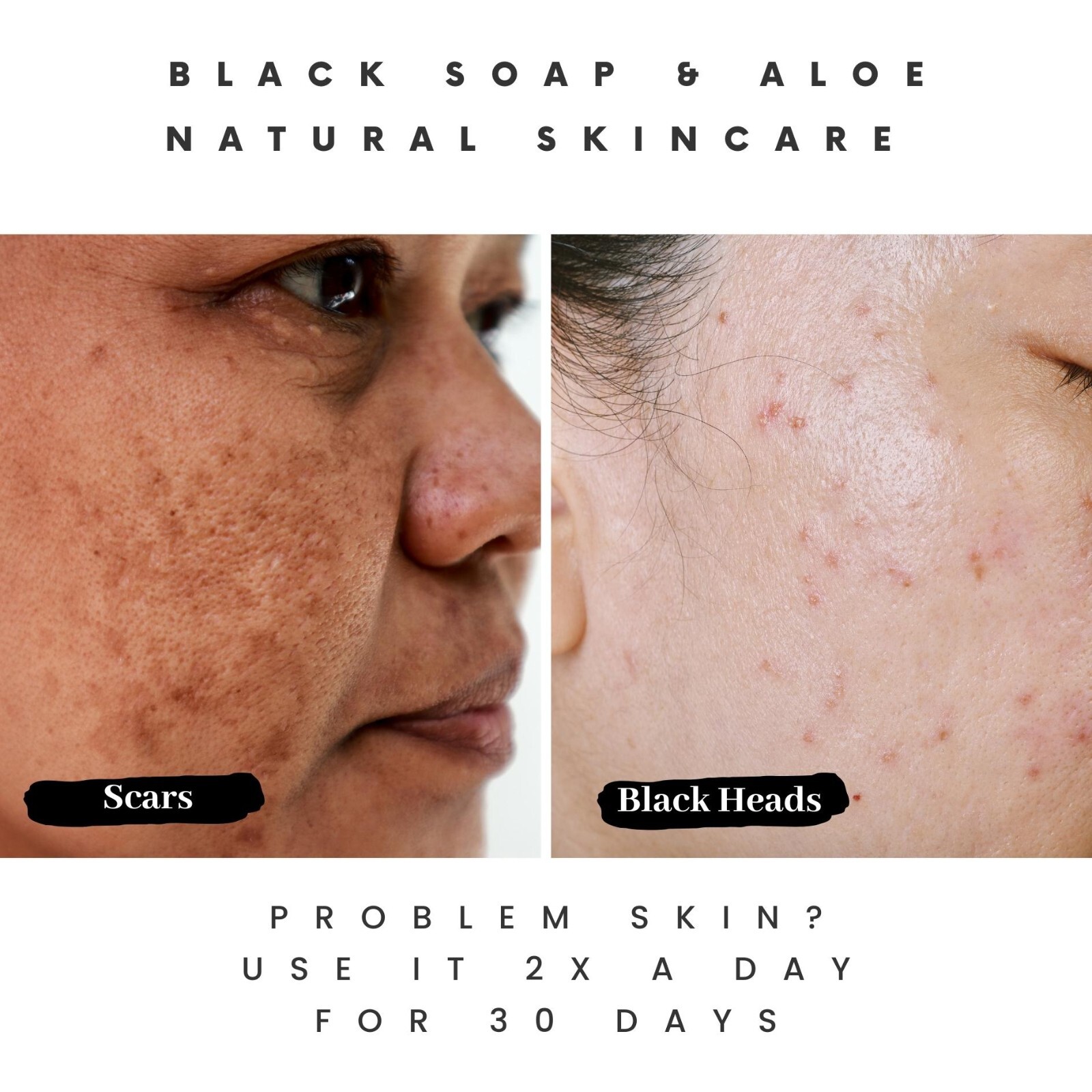 Navigating Acne Soap Options on eBay