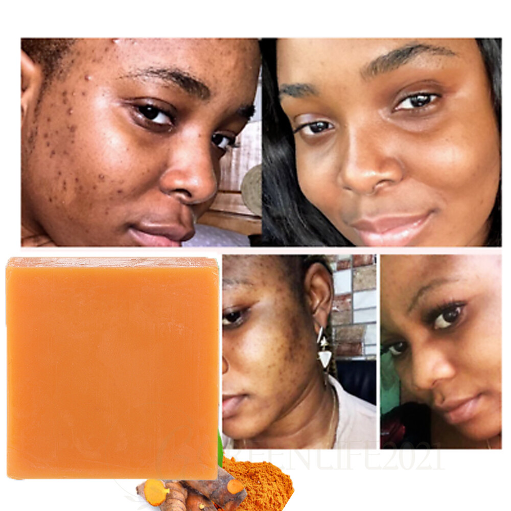 2pcs Tumeric Soap For Dark Spots, Skin Lightening, Anti Acne Skin Cleansing Soap
