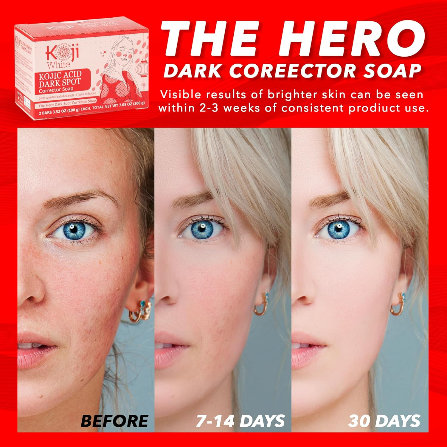 Koji White Kojic Acid Dark Spot Corrector Soap – Kojic Acid Soap with Vitamin C,
