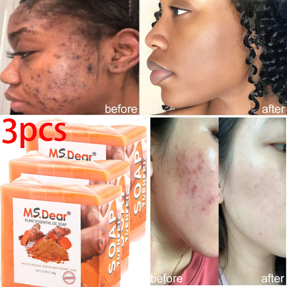 3×Tumeric Soap Ginger Anti-Acne Dark Spots Scars Removal Body Whitening Soap Bar