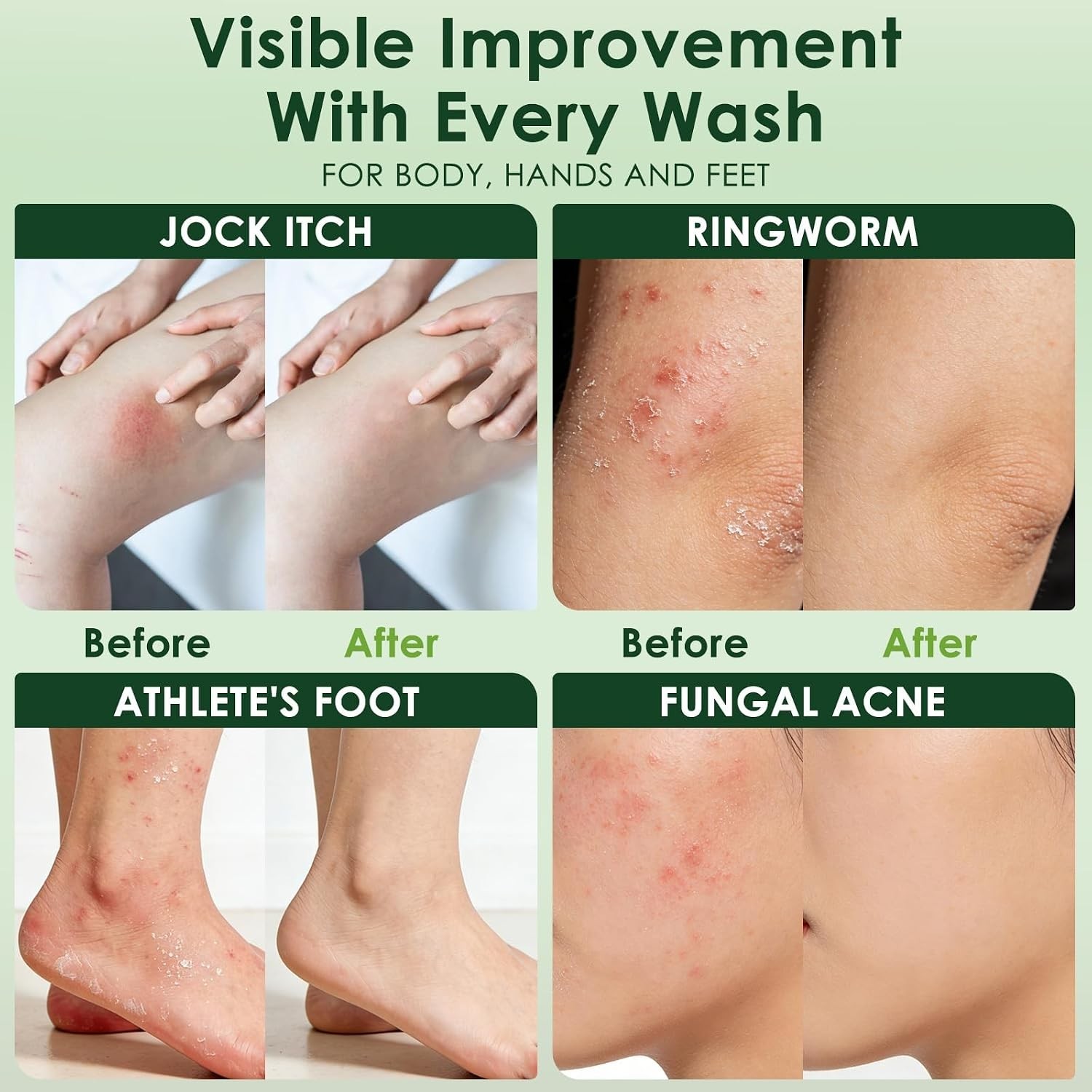 Tea Tree Antifungal Soap Bar – Skin Relief for Acne, Athlete’s Foot & More