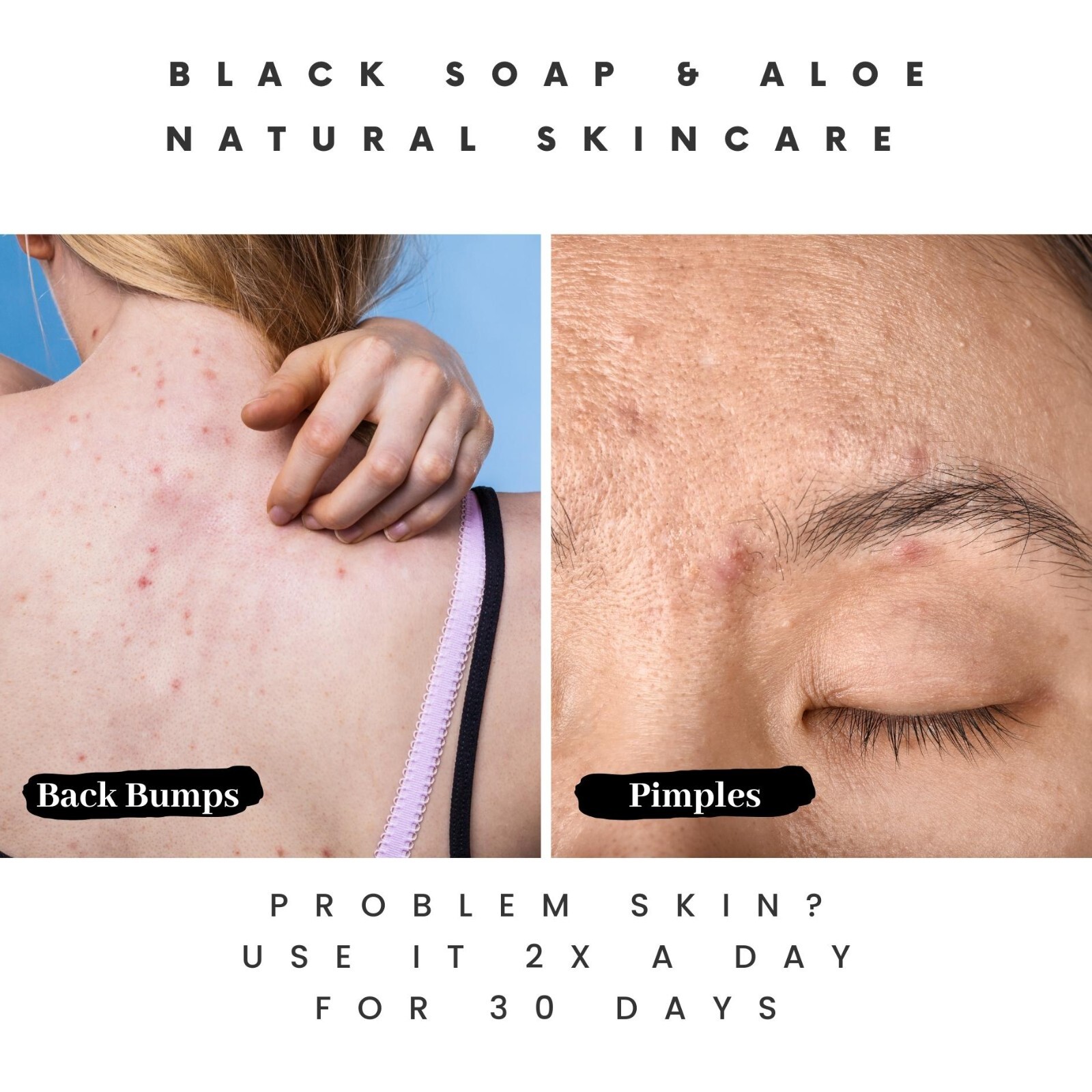 Navigating Acne Soap Options on eBay