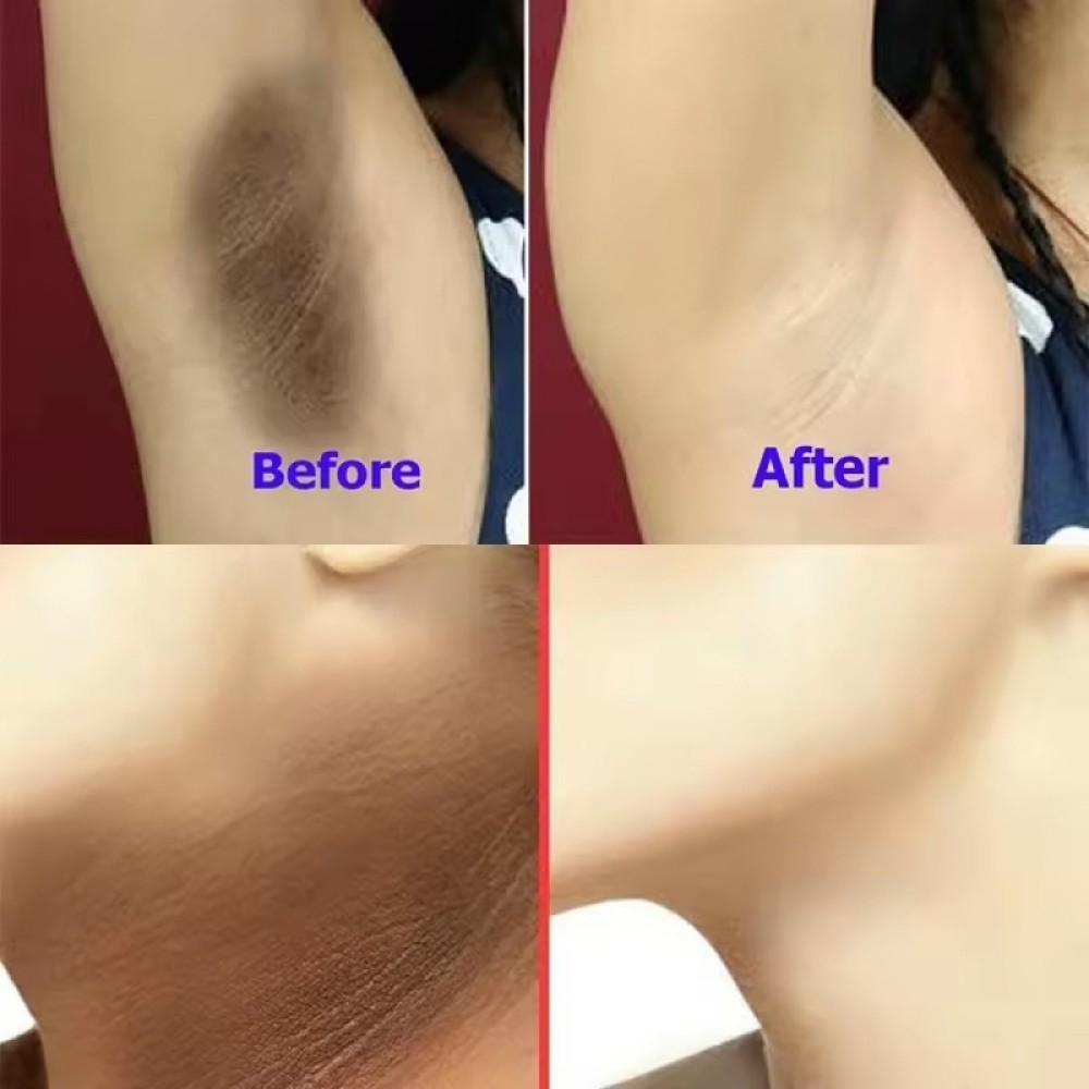 1-5X Kojic Acid Soap Dark Spot Whitening Turmeric Skin Bleaching Lightening 100G
