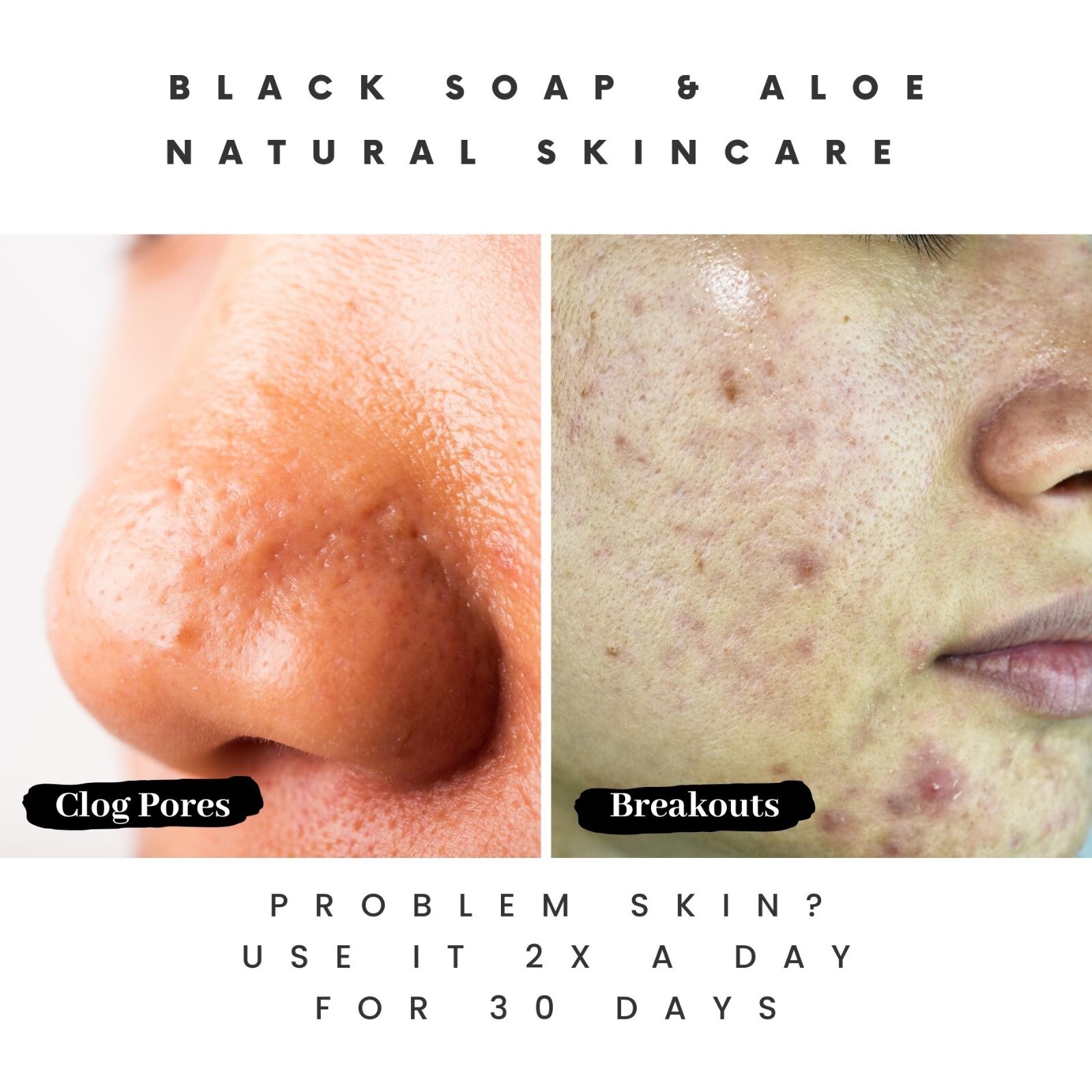 Navigating Acne Soap Options on eBay