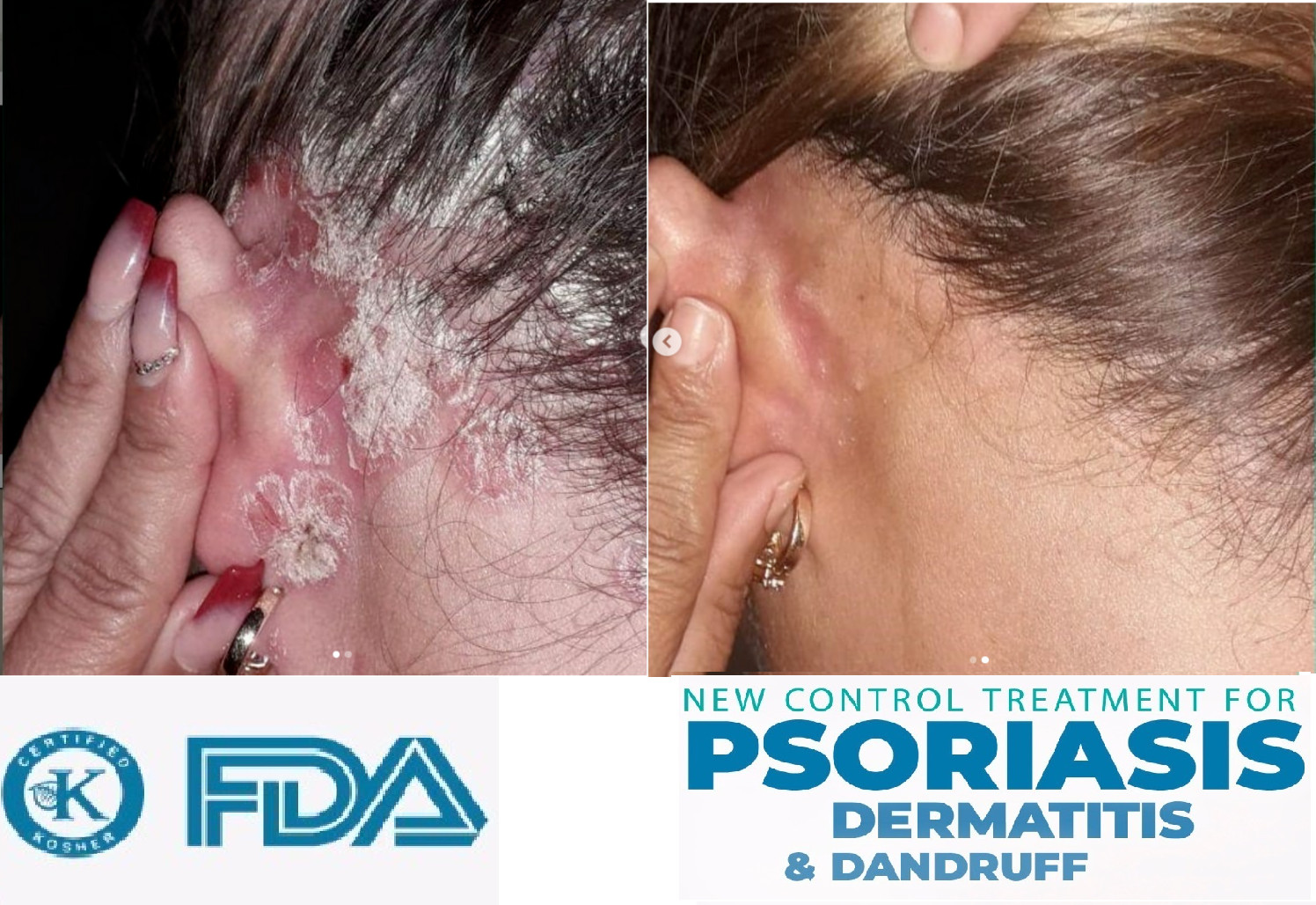 Dandruff Psoriasis Seborrheic Dermatitis 3 Pack Dermabon natural