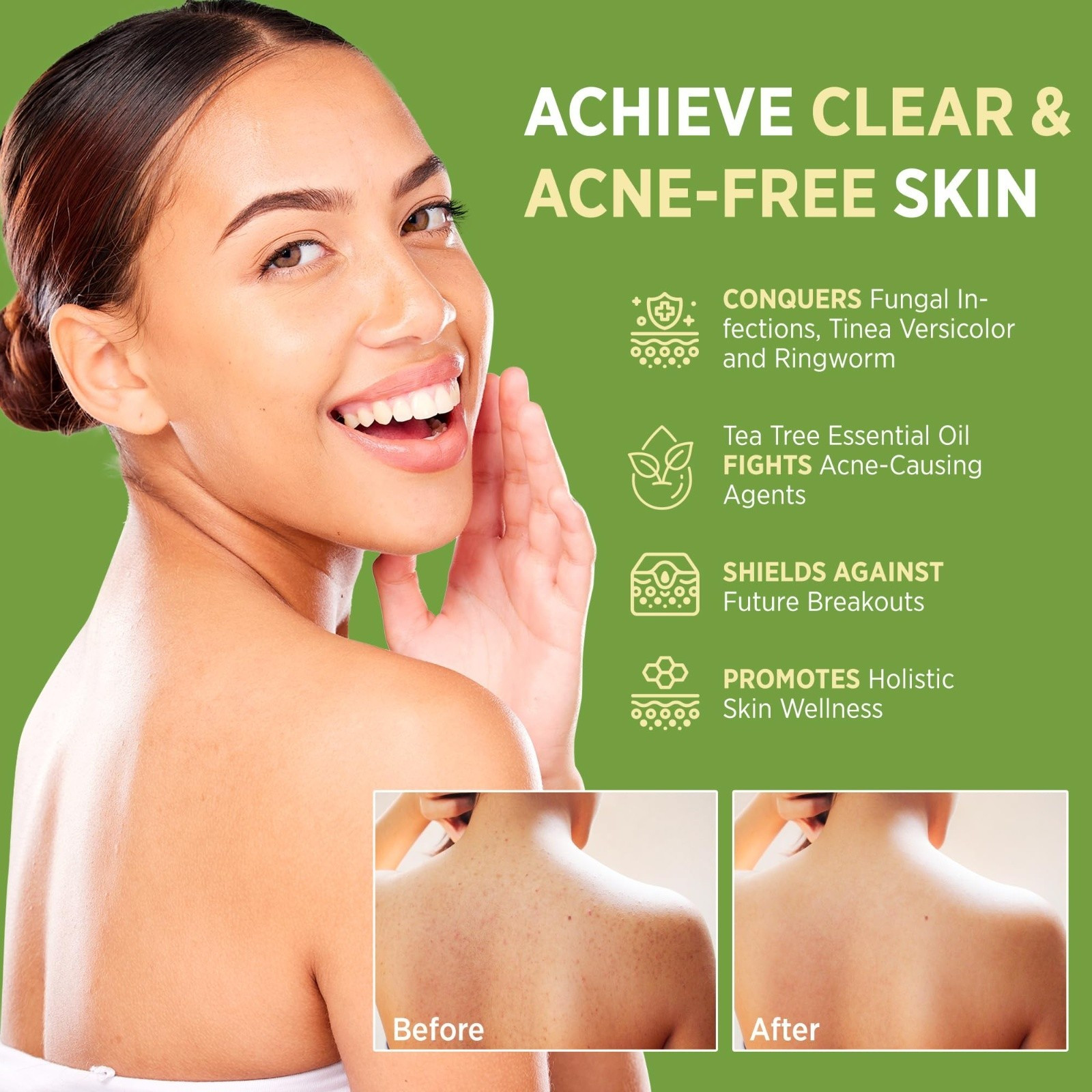 Roycederm Antifungal Antibacterial Tea Tree Soap | Treatment Soap for Face &…