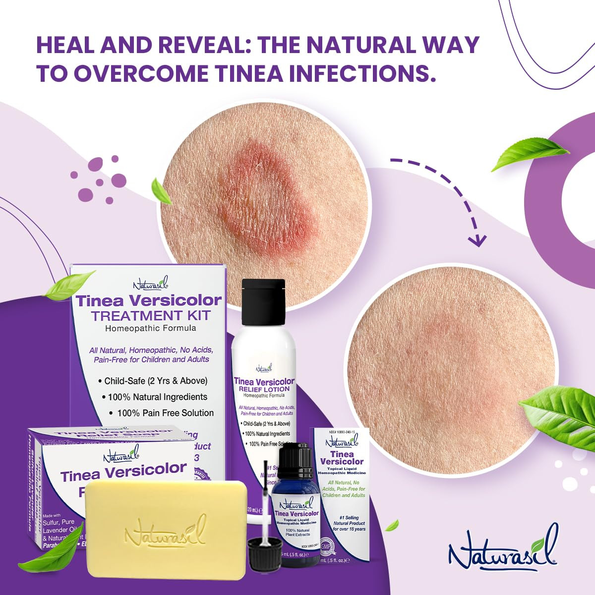 Natural Tinea Versicolor Relief Anti-Itch Sulfur Soap | Best for Tinea, Ringworm