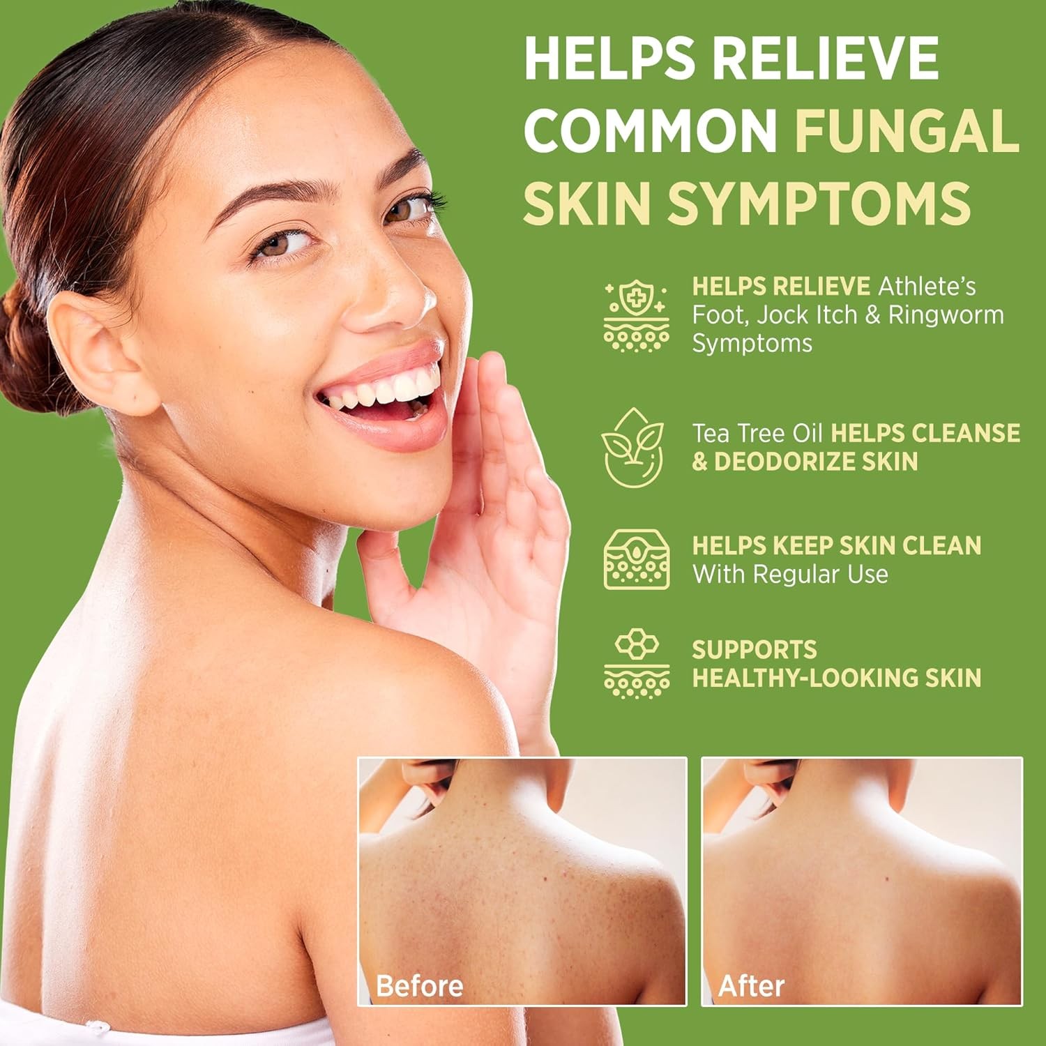 Roycederm Antifungal Bar Soap – Tea tree Oil Soap – Athlete’s Foot Treatment f