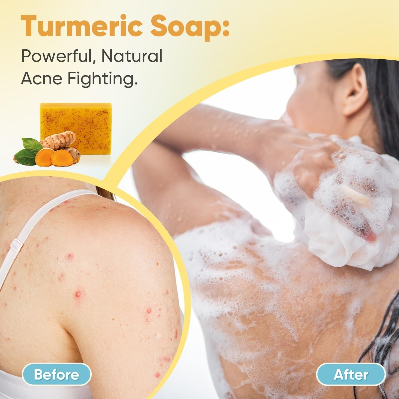 Treeroot Turmeric Soap 5 Pack – Kojic Acid & Vitamin C, Natural Ingredients